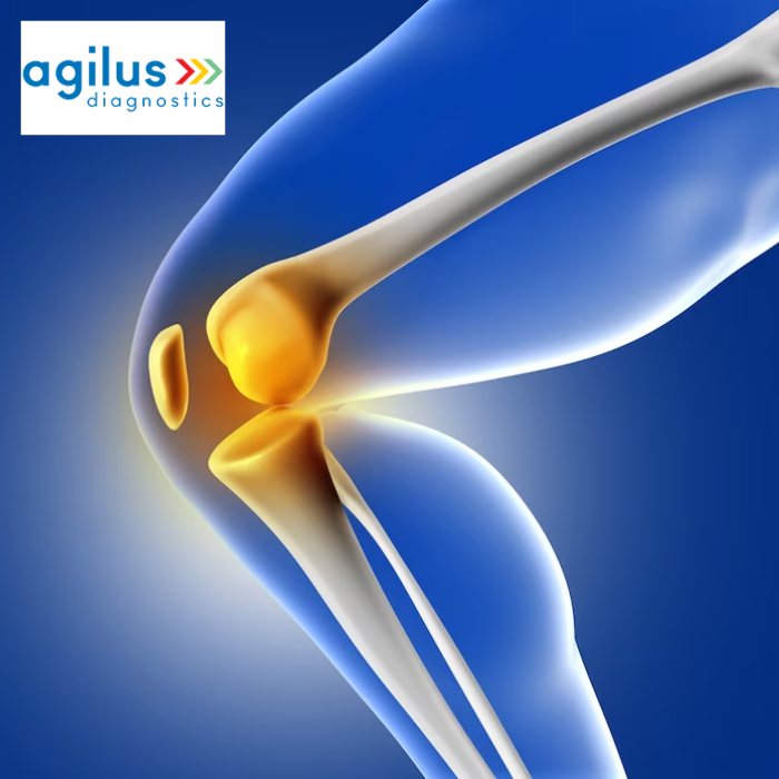 Mervin Rickets Rickets - Symptoms, Causes And Treatment - Agilus Diagnostics